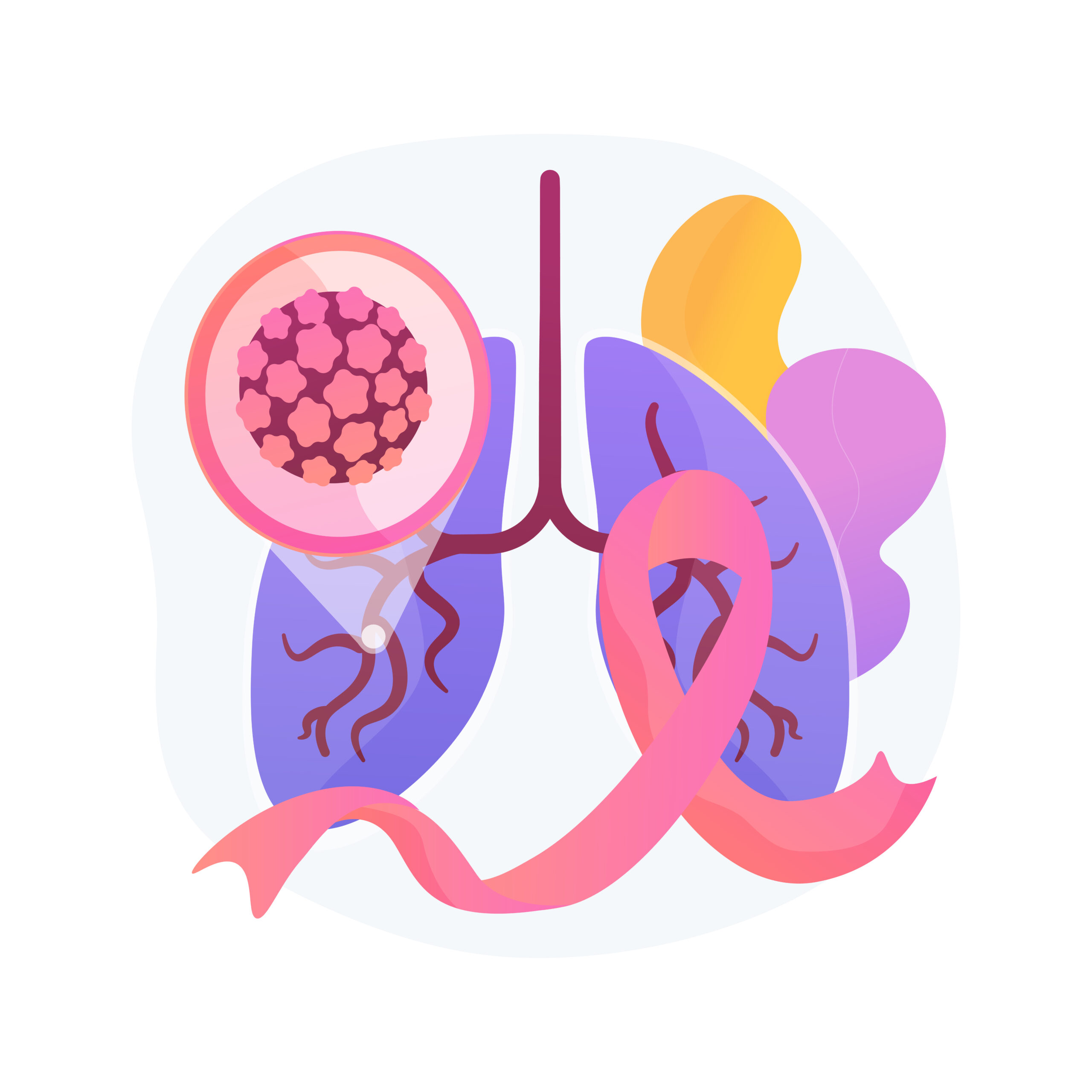 Lung cancer abstract concept vector illustration. Oncology early stage diagnostics, tumor risk factor, lung cancer treatment, fighting disease, chemical therapy, oncology abstract metaphor.